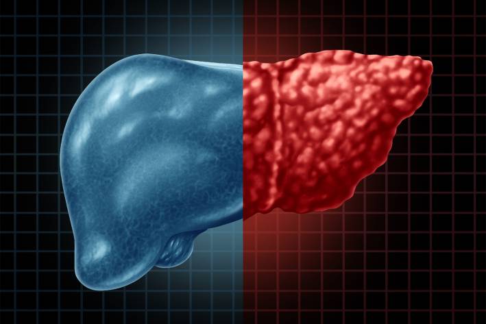 an illustration of a healthy liver compared to an unhealthy liver