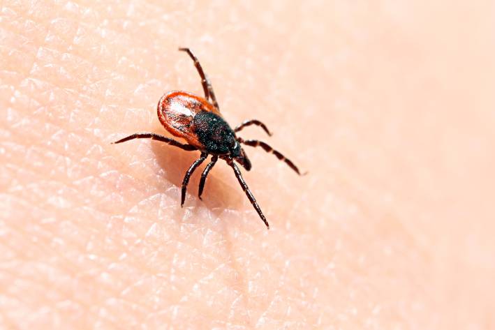 Uncovering Lyme Disease a tick on human skin