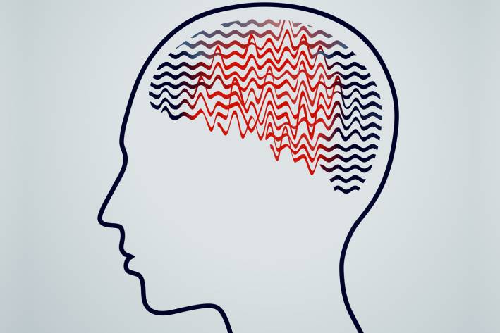 Epilepsy an illustration of erratic brainwaves